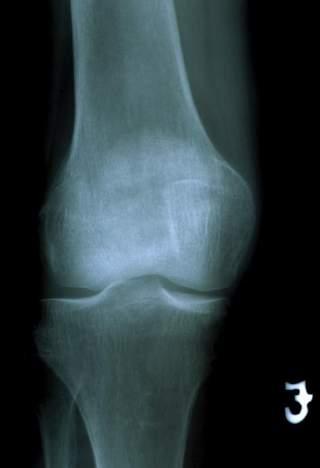 Patella