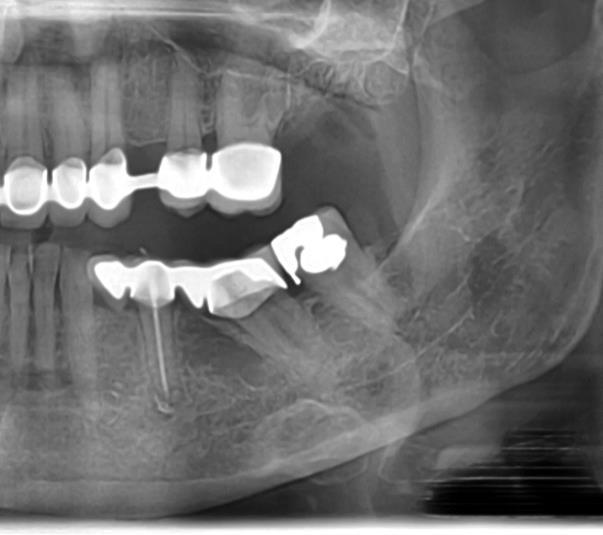 21 Felhasznált irodalom Ahlgren FK, Johannessen AC, Hellem S: Displaced calcium hydroxide paste causing inferior alveolar nerve paraesthesia: report of a case.