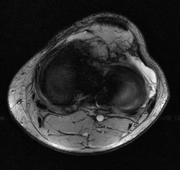 A lateralis meniscus parameniscalis cystái az esetek 20 60%-ában tapinthatók.