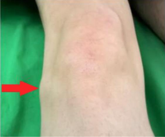 2/a, b ábra Lateralis meniscus cysta klinikai megjelenése A meniscustesztek negatívak voltak.