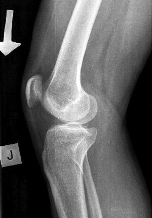 Kétirányú röntgenfelvételen a terimének megfelelően a tibia lateralis condylusán csonterózió volt látható (3/a és 3/b ábr.