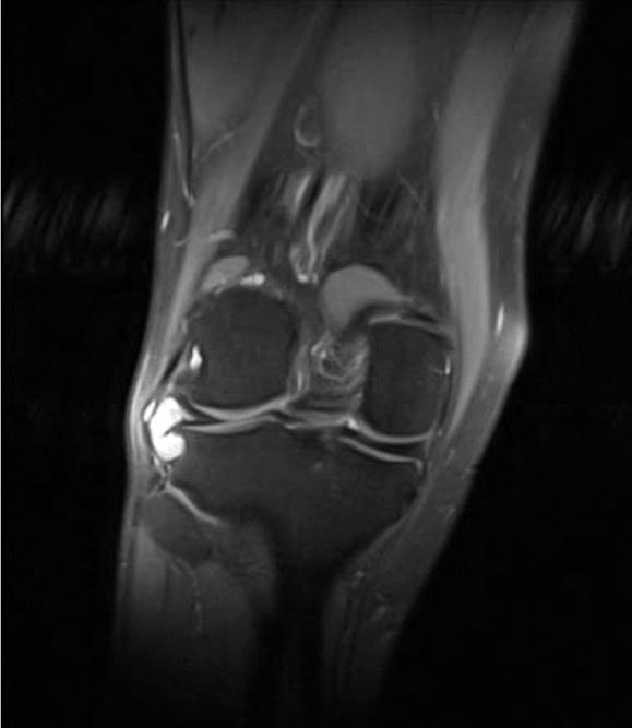4/a, b ábra Jobb térd PDFS coronalis és T2 axiális MR-felvétele a tibiacondylus erózióját okozó lateralis meniscus cystával MR = mágneses rezonancia; PDFS = zsírelnyomásos