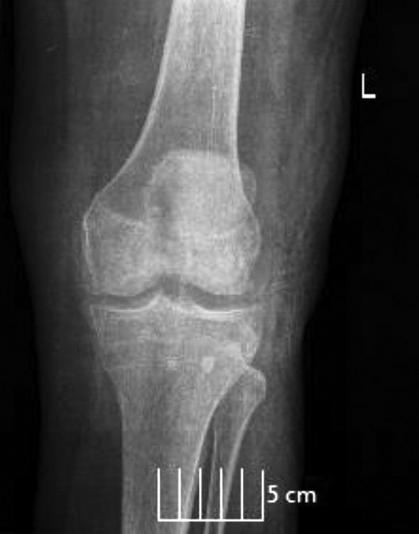 Betegünknél a fizikális lelet és panaszrendszer alapján az előző két esethez hasonlóan a lateralis meniscus cysta merült fel bennünk elsődleges diagnózisként.