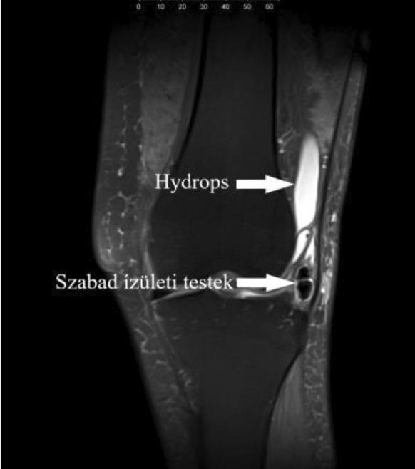 medialis femorotibialis ízületben grade 3 4., a lateralis femorotibialis ízületben grade 2 3. chondropathiát találtunk; a meniscusok épek voltak.