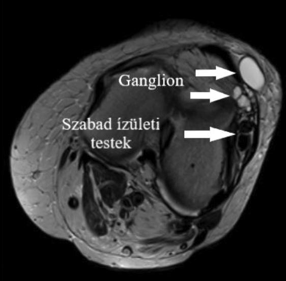 Megbeszélés c) 6/a, b, c ábra Bal térd T2 FS coronalis és sagittalis, valamint T2 axiális MRfelvétele, multilocularis ganglion cysta, a lateralis recessusban 2 darab szabad ízületi testtel MR =