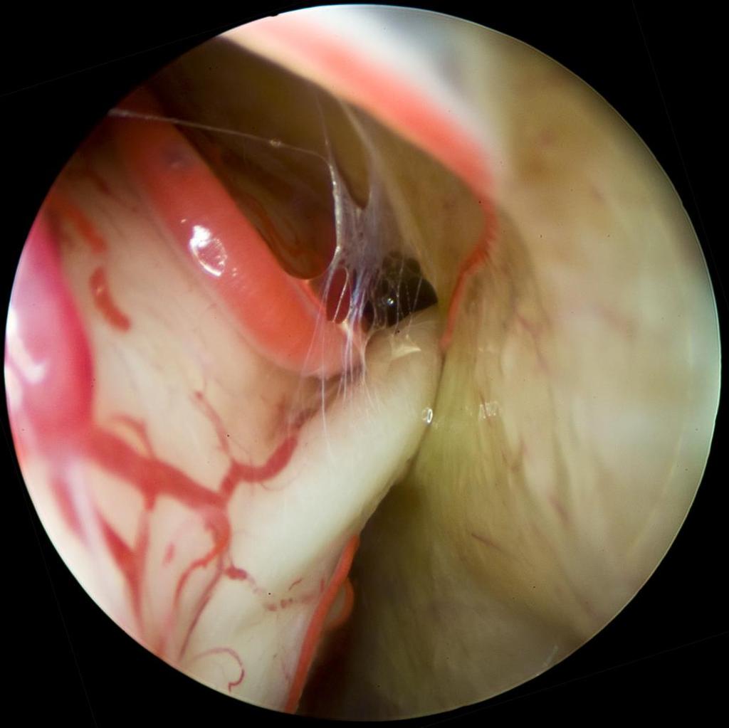Kilépési pontok, intracranialis topogáfia Cisterna pontis lateralis Porus duralis nervi trigemini Sulcus et impressio nervi