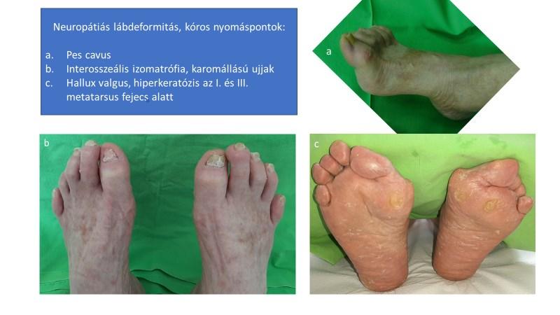 a gangréna foot diabetes mellitus kezelése hidrogén-peroxid)