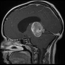 GLIOMÁK- a gliasejtekből származó neuroepithelialis tumorok (astrocyták, oligodendrocyták, ependyma sejtek) 1. ASTROCYTOMÁk https://www.urmc.rochester.