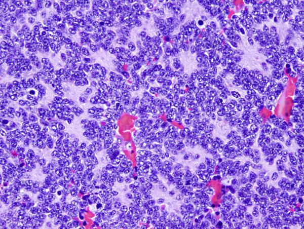 Klasszikus medulloblastoma: Kis kék kereksejtes tumor Differenciálatlan, embryonalis tumorsejtek