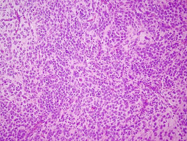 SZÖVETTANI MEGJELENÉS International Neuroblastoma Pathology Classification a