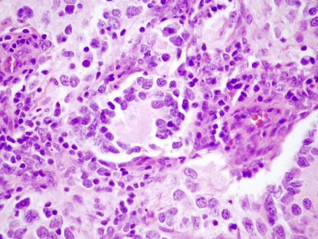 Neuroblastoma Neuroblastok, nincs Schwann sejtes differenciáció (stromal cells) = stroma