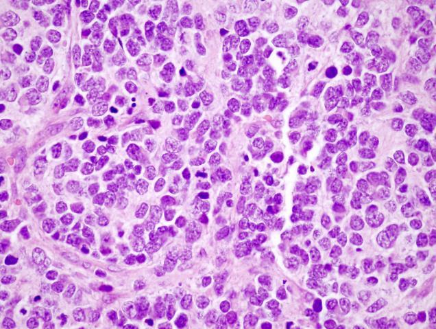 Homer-Wright pseudorozetta Differenciáldiagnózis: Kis kék kereksejtes tumorok: lymphoma,