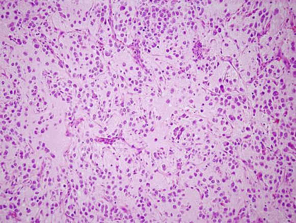 2. Ganglioneuroblastoma