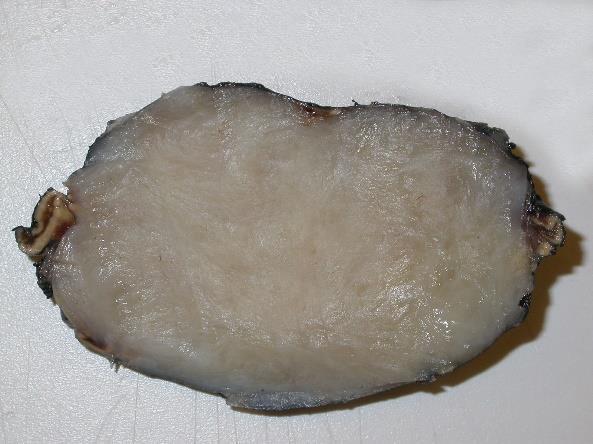 neuroblastok)