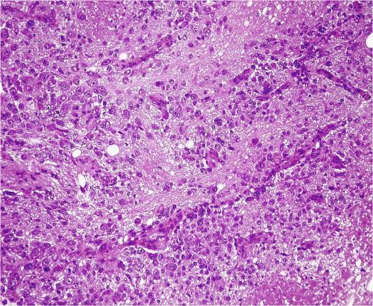 nodularis) 3.