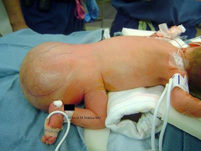 Teratomák: Benignus cyticus vagy solid malignanus (éretlen szöveti elemek)