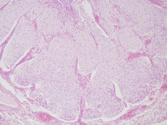ovarialis, mediastinalis, retroperitonealis 75 % benignus (érett szöveti