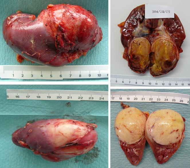 vizeletben (20%) hypertonia metastasis: tüdő