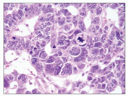 blastema Anaplasia: multipoláris