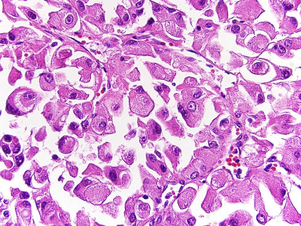 Egyéb gyermekkori malignus vesetumorok: Clear cell sarcoma (csontáttétek) Rhabdoid tumor: nagyon rossz prognózis