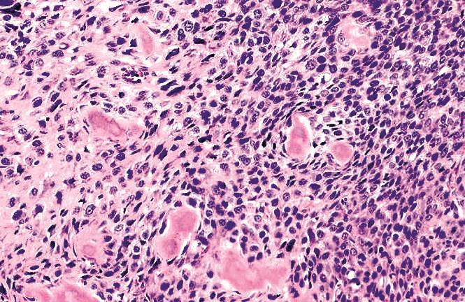 Szövettan: Osteoid (tumorsejtek által termelet amorf, eosinophil anyag