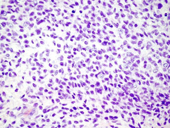 Szövettan: Klasszikus Ewing sarcoma primitív tumorsejtek neuralis differenciáció jelei nélkül kis, kerek tumorsejtek, hyperchrom maggal