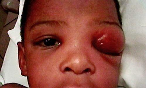 Orbital cellulitis Phtisis bulbi: