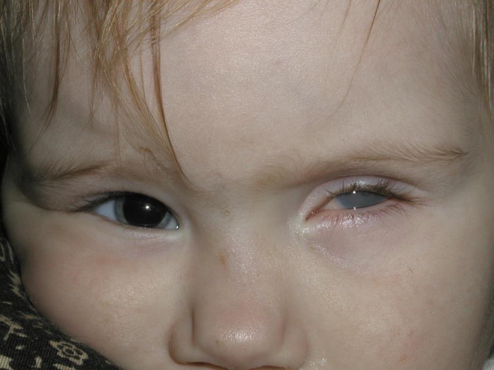 Bilateral Retinoblastoma Presenting