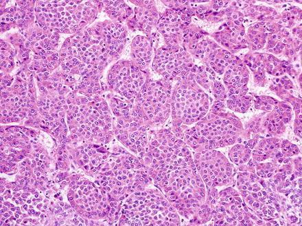 com/malignantpediatric-liver-tumors/ Tisztán