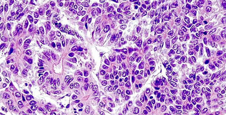 cell: glycogen, lipid) Embryonalis Macrotrabecularis