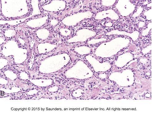 o fibroma, chondroma, lipoma, osteoma, meningeoma,
