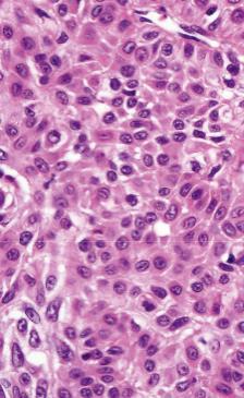 rhabdomyoma Epithelialis eredetű tumorok: mikro-