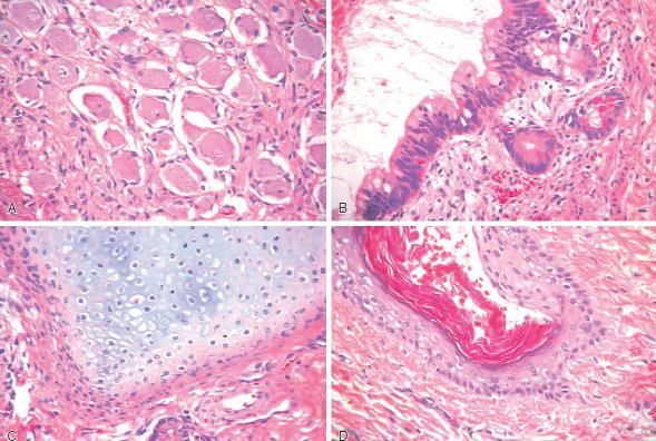 megy át, pl: o Pleomorf adenoma (nyálmirigy kevert tumora) Epithel sejtek + myoepithel
