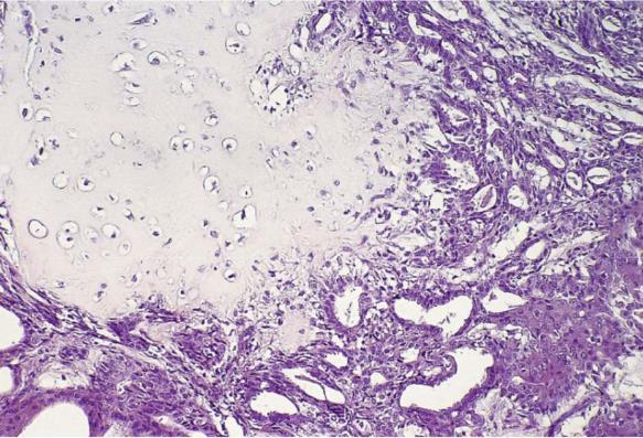 származó sejteket tartalmaz Ovarium, testis; középvonalban embryonalis maradvány o