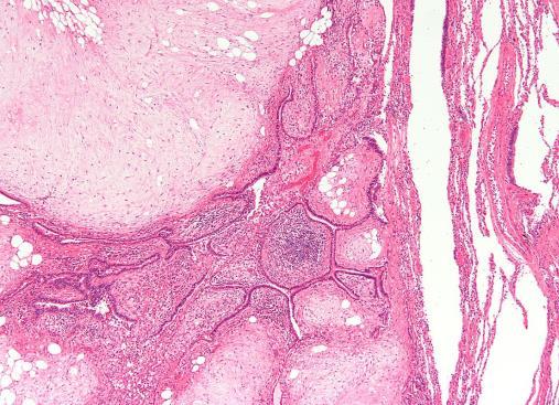 Hamartoma és choristoma Hamartoma Vsz.