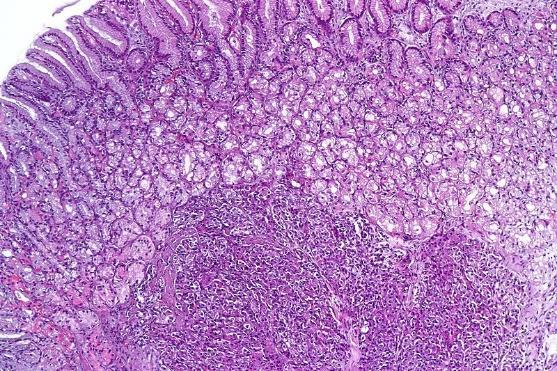 org/wikipedia/commons/6/6d/pulmonary _hamartoma_-_low_mag.