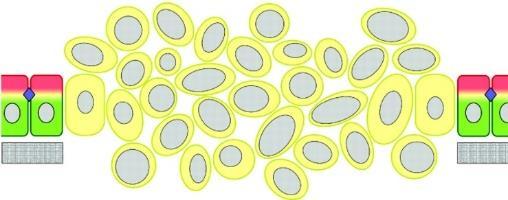 Rhabdomyosarcoma Kóros sejtmag morfológia: ,