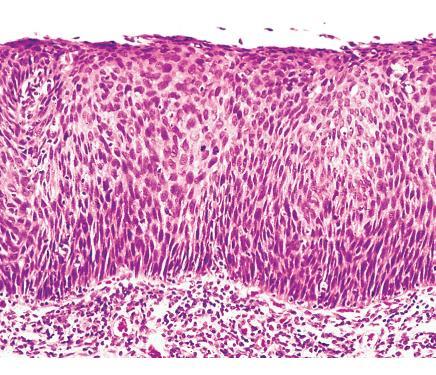 Dysplasia = intraepithelialis neoplasia (prekurzor lézió) Rendellenes