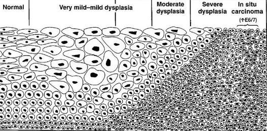 10 Carcinoma, enyhe és mérsékelt dysplasia regrediálhat Ha súlyos a