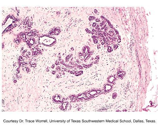 carcinomas: a morphometric and molecular genetic study; :