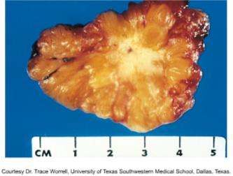 emlőcarcinoma Környező szöveteket infiltrálja és károsítja