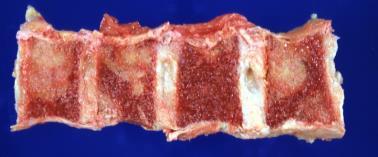 vese-, húgyhólyag carcinoma Paravertebralis plexus (gerinc környéki tu): csigolya