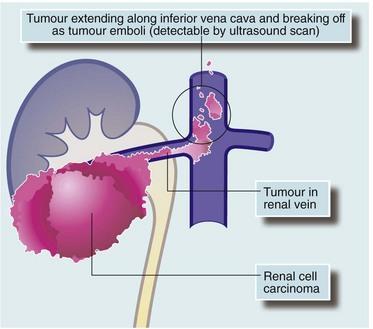 -k a vénákban is növekedhetnek Vesesejtes carcinoma (v. cava inf.