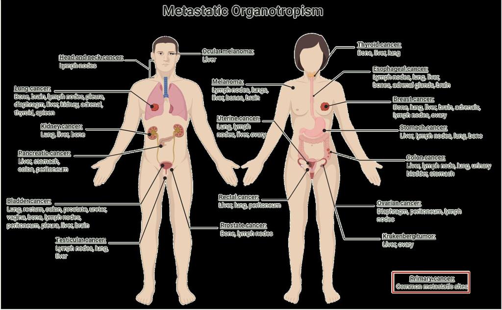 Jellegzetes metastasis helyek Nem minden magyarázható az anatómiai nyirok- és vénás elvezetéssel Fares, J., Fares, M.Y., Khachfe, H.H. et al.