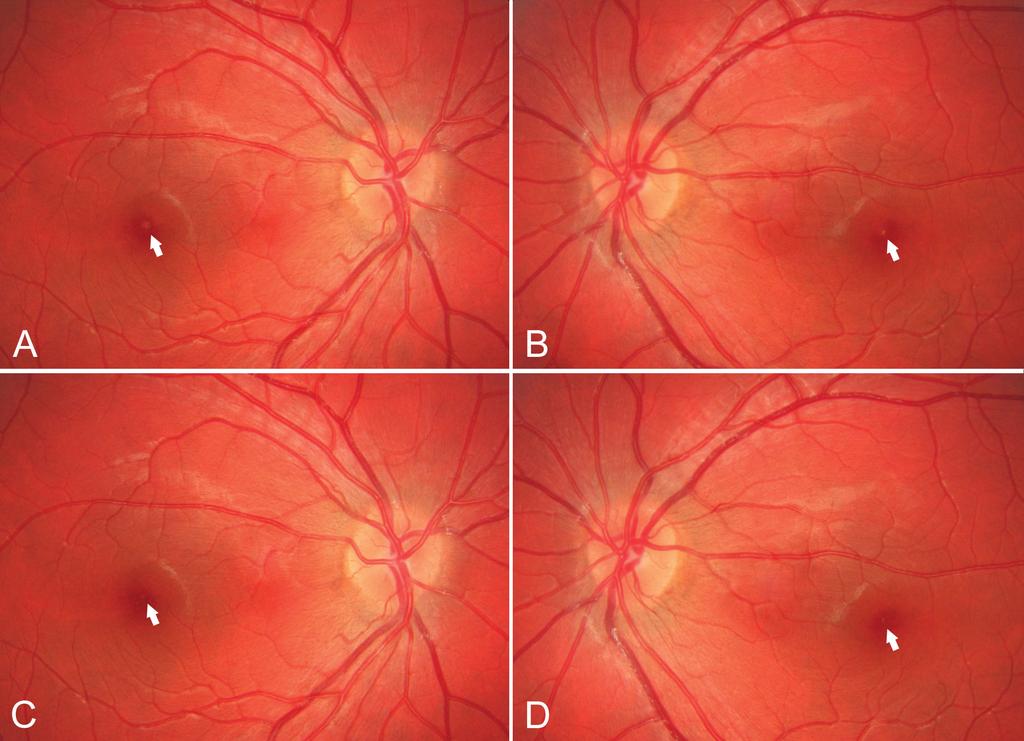 A solaris retinopathia a retina pigmentepitheliumának (RPE) és a fotoreceptorok külső szegmensének nagyrészt fotokémiai, kisebb részben termikus és mechanikus károsodása [1].