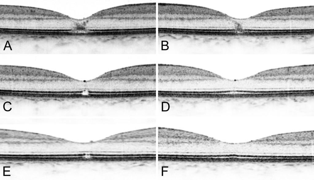 rétegbe való V alakú radiációjával (2. ábra: A, B). A retina vastagsága normális volt. A mikroperimetriás vizsgálat során mindkét oldalon a laesiókkal megegyező területeken érzékenységcsökkenés (3.