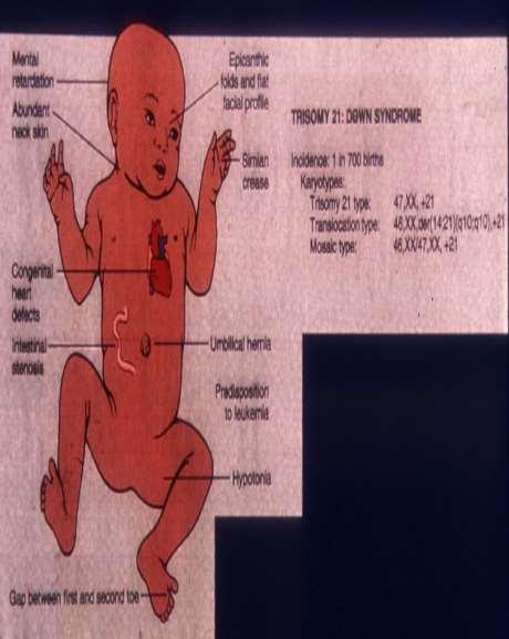 Down syndroma: széles, lapos arc Epicanthus Makroglossia Négy ujj redő
