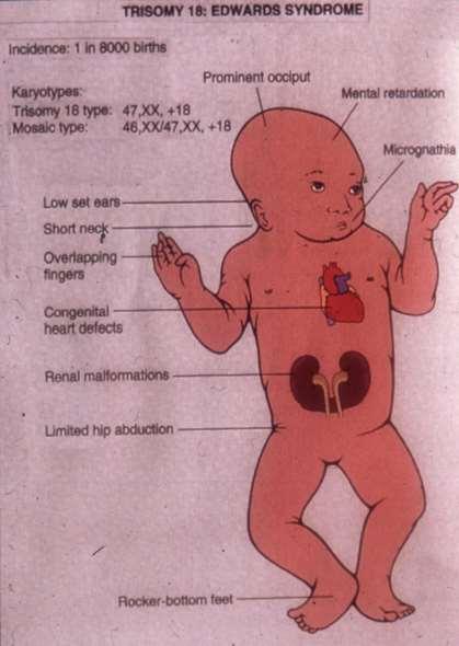 Edwards syndroma: 18 Chr.