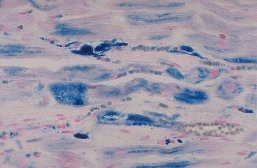 hemochromatosis, with excessive iron deposition - Prussian blue iron