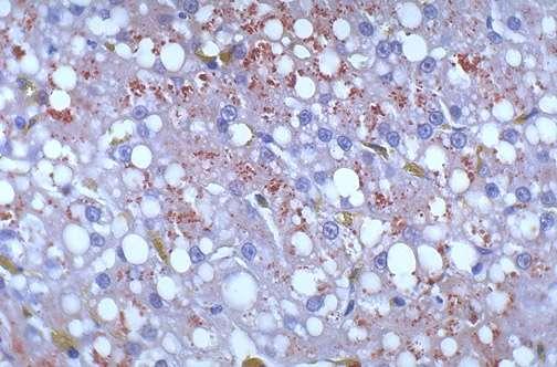 excessive lysosomal copper in a patient with the